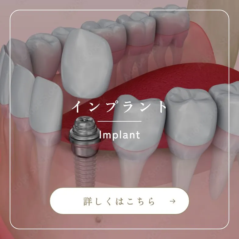 錦糸町の歯医者・歯科｜ホワイトデンタルクリニック錦糸町のインプラント