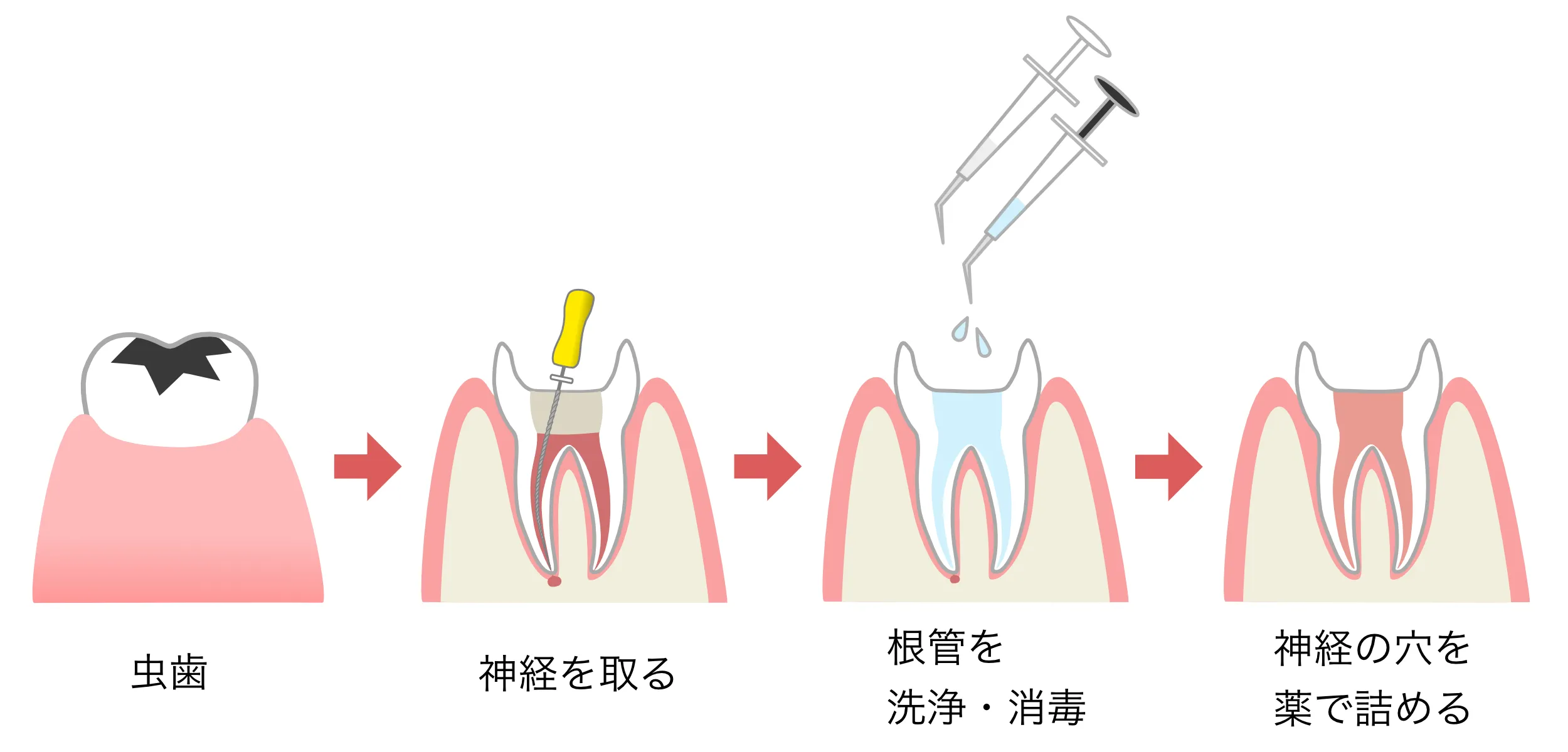 根管治療　イラスト