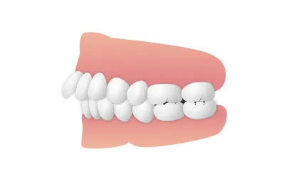 出っ歯（上顎前突）|錦糸町の矯正歯科 ホワイトデンタルクリニック錦糸町院墨田区院
