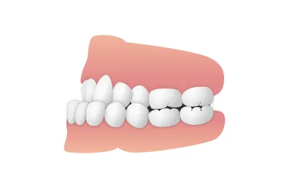 受け口（下顎前突）|錦糸町の矯正歯科 ホワイトデンタルクリニック錦糸町院墨田区院
