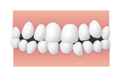 乱杭歯／叢生|錦糸町の矯正歯科 ホワイトデンタルクリニック錦糸町院墨田区院