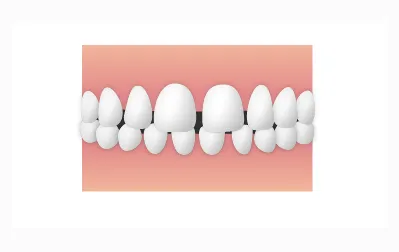 すきっ歯／空隙歯列|錦糸町の矯正歯科 ホワイトデンタルクリニック錦糸町院墨田区院
