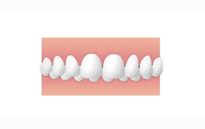 過蓋咬合|錦糸町の矯正歯科 ホワイトデンタルクリニック錦糸町院墨田区院