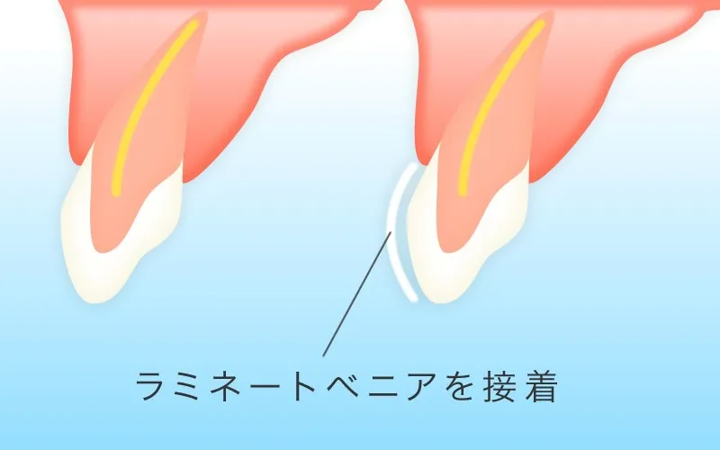 2. ラミネートベニア法