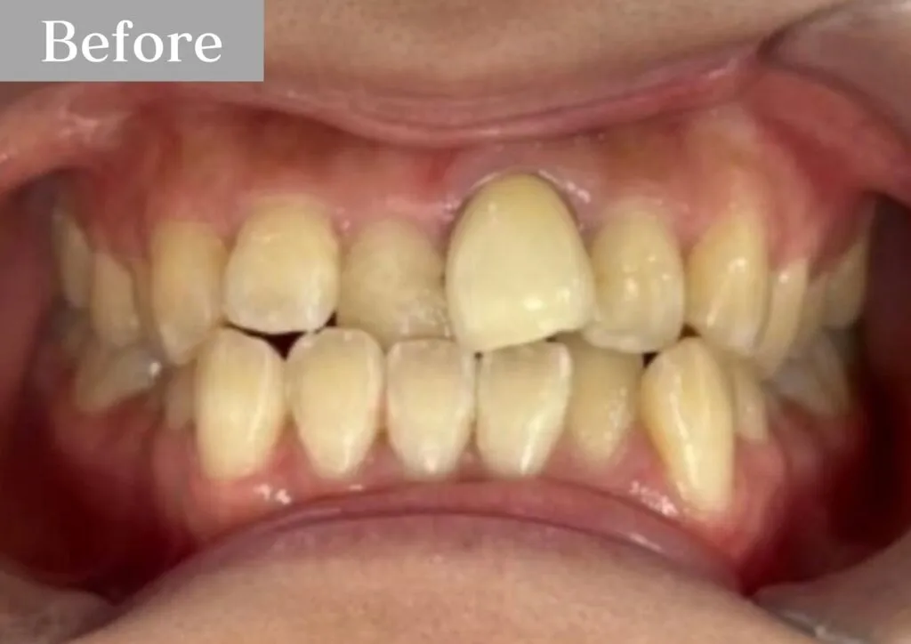 錦糸町の歯医者・歯科|インビザライン①before|錦糸町の歯医者 ホワイトデンタルクリニック錦糸町