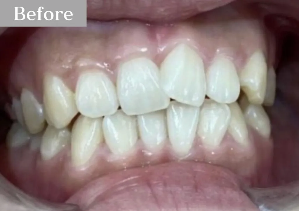 錦糸町の歯医者・歯科|インビザライン②before|錦糸町の歯医者 ホワイトデンタルクリニック錦糸町