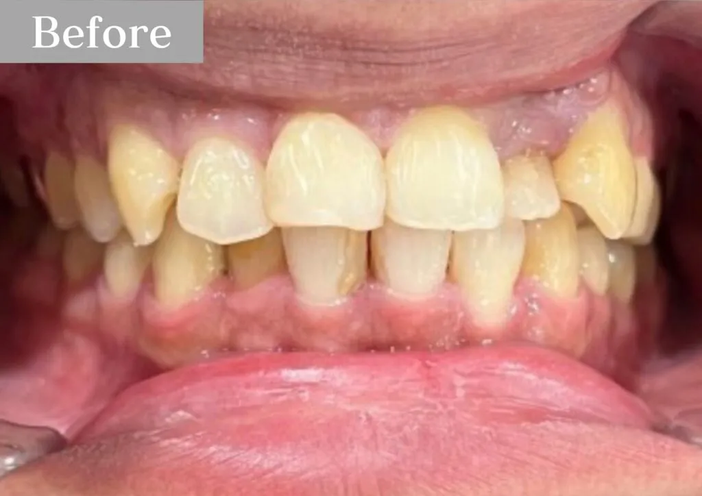 錦糸町の歯医者・歯科|インビザライン③before|錦糸町の歯医者 ホワイトデンタルクリニック錦糸町