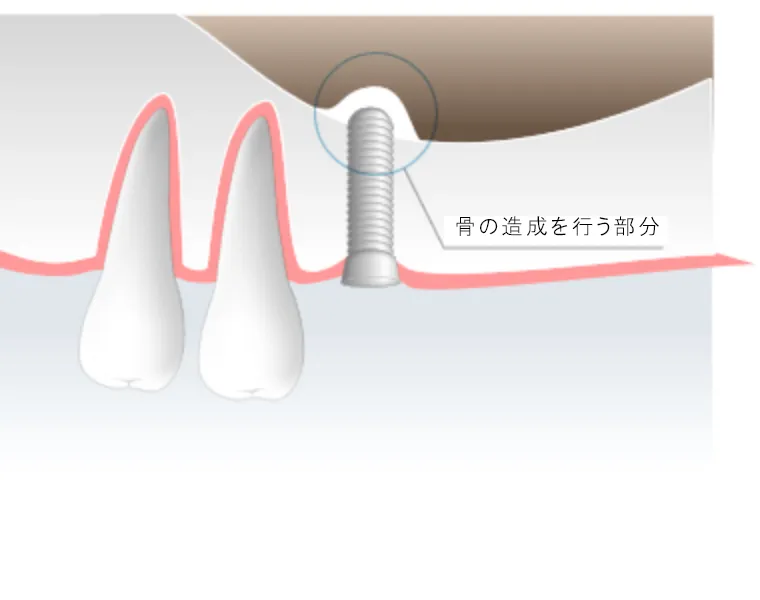 ソケットリフト法（上顎洞底挙上術）