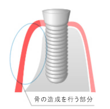 インプラント埋入時　GBR(骨誘導再生)