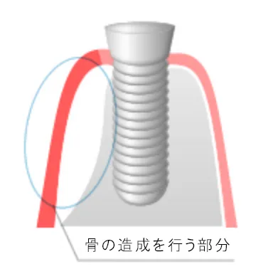 インプラント埋入時　GBR(骨誘導再生)