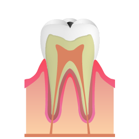 小さなむし歯(C1)|錦糸町の歯医者・歯科|ホワイトデンタルクリニック錦糸町