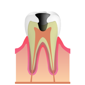 大きなむし歯(C3/C4)|錦糸町の歯医者・歯科|ホワイトデンタルクリニック錦糸町