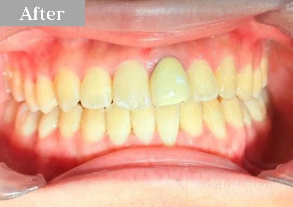 錦糸町の歯医者・歯科|インビザライン①after|錦糸町の歯医者 ホワイトデンタルクリニック錦糸町