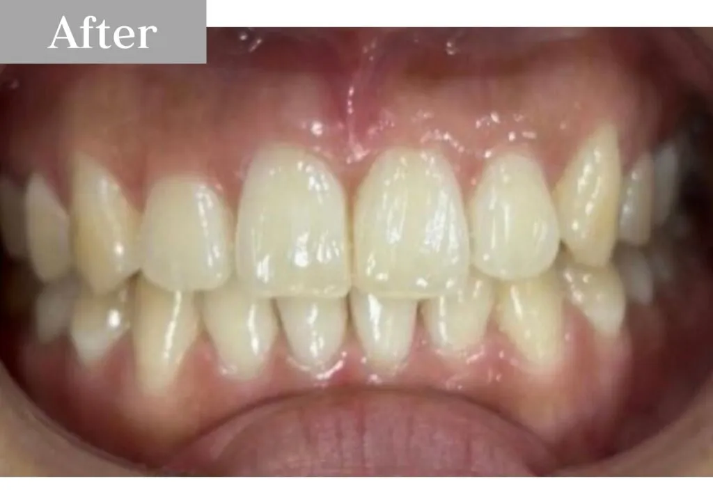 錦糸町の歯医者・歯科|インビザライン②after|錦糸町の歯医者 ホワイトデンタルクリニック錦糸町