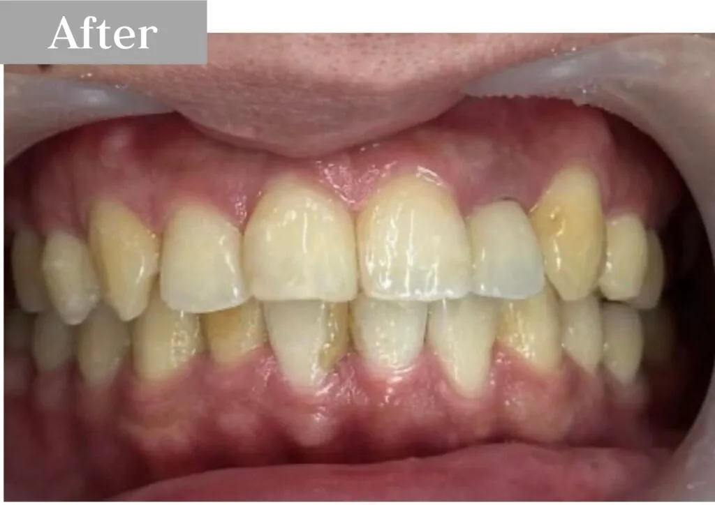 錦糸町の歯医者・歯科|インビザライン③after|錦糸町の歯医者 ホワイトデンタルクリニック錦糸町