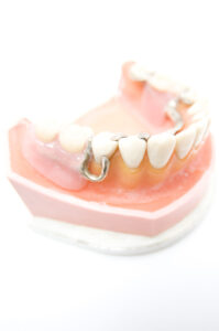 入れ歯模型|錦糸町の歯医者 ホワイトデンタルクリニック錦糸町院