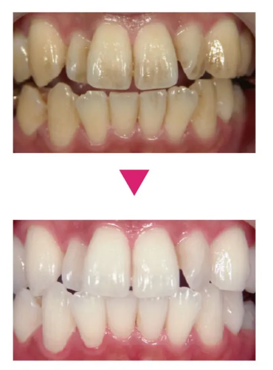ホワイトニングイメージ|錦糸町の歯医者・歯科 ホワイトデンタルクリニック銀糸町院