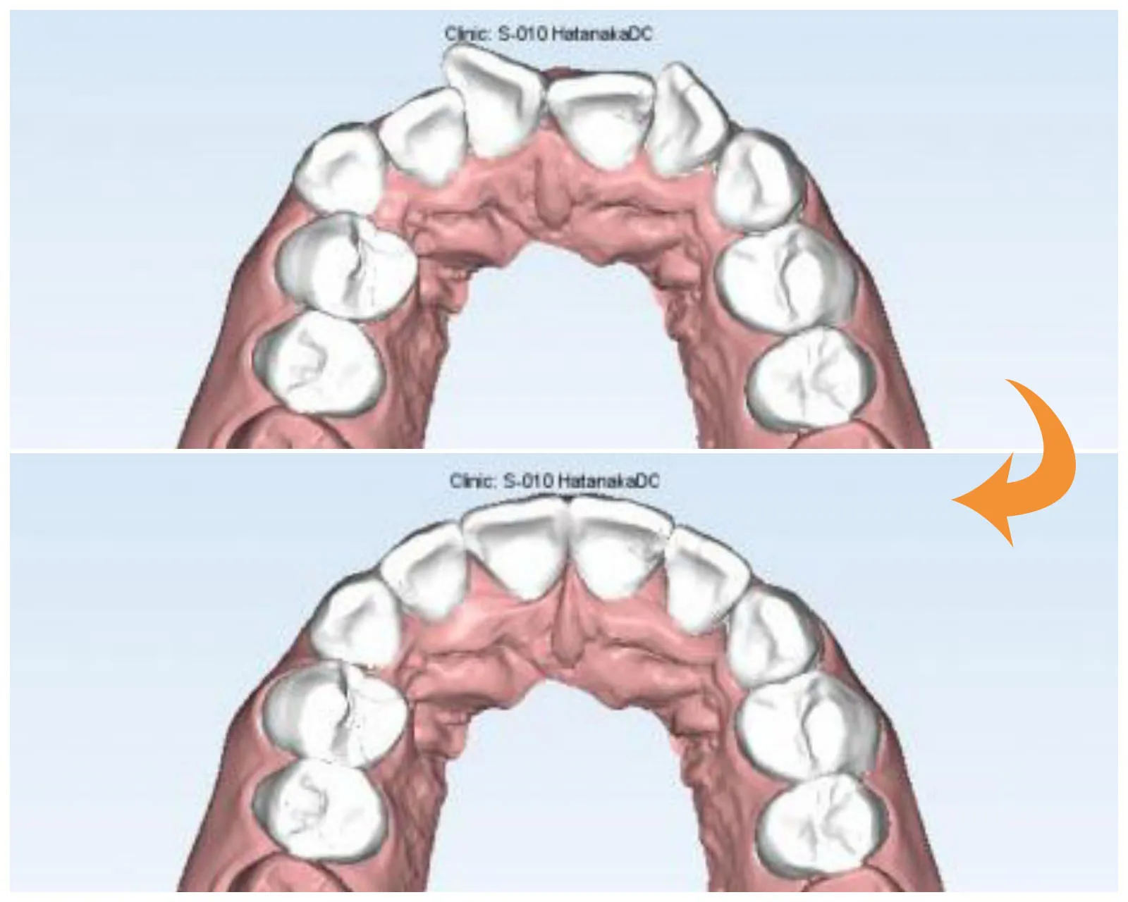 5.矯正治療前にシミュレーションを確認できる|錦糸町のマウスピース矯正歯科 ホワイトデンタルクリニック錦糸町院 墨田区院