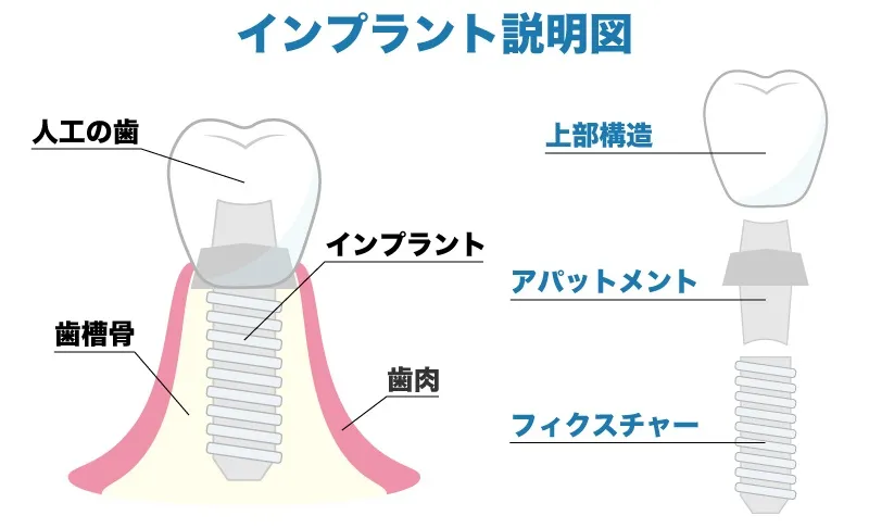 インプラント構図の説明|墨田区錦糸町の歯医者・歯科 ホワイトデンタルクリニック錦糸町院