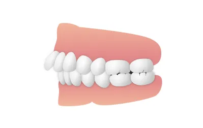 骨格や歯並びの問題も大きな要因です。