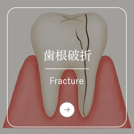 錦糸町の歯医者・歯科｜ホワイトデンタルクリニック錦糸町の歯根破折