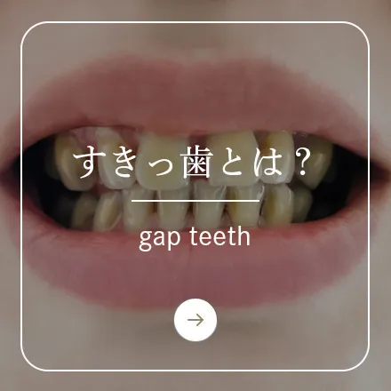 錦糸町の歯医者・歯科｜ホワイトデンタルクリニック錦糸町のすきっ歯とは？