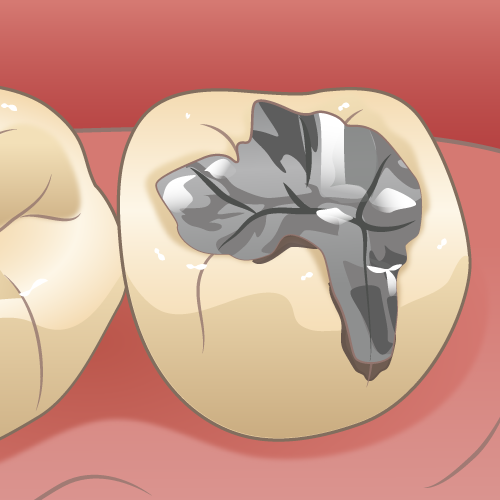 銀歯の問題点